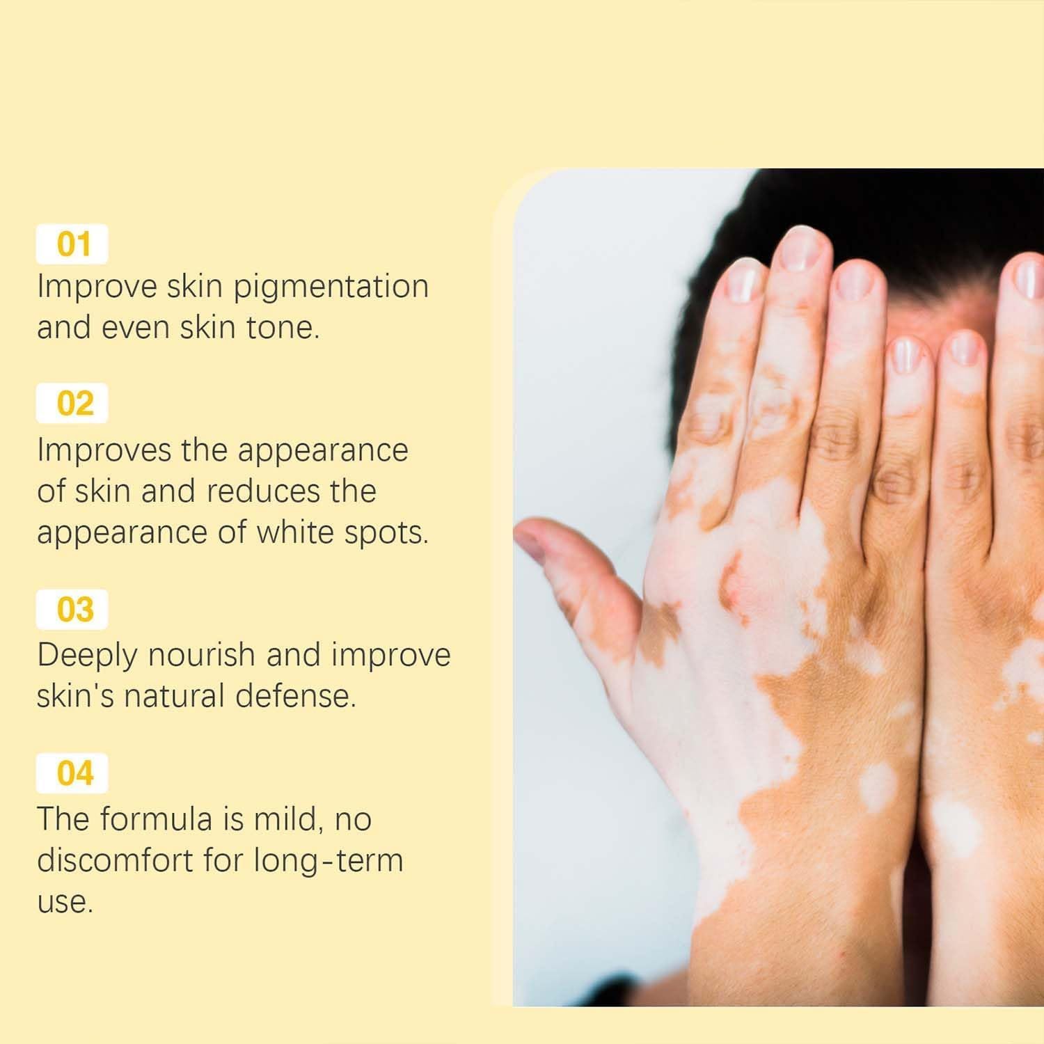 Bee Venom Vitiligo Cream, Beevenom Vitiligo Treatment Cream for All Skin Types
