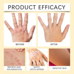 Bee Venom Vitiligo Cream, Beevenom Vitiligo Treatment Cream for All Skin Types