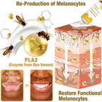 Bee Venom Vitiligo Cream, Beevenom Vitiligo Treatment Cream for All Skin Types