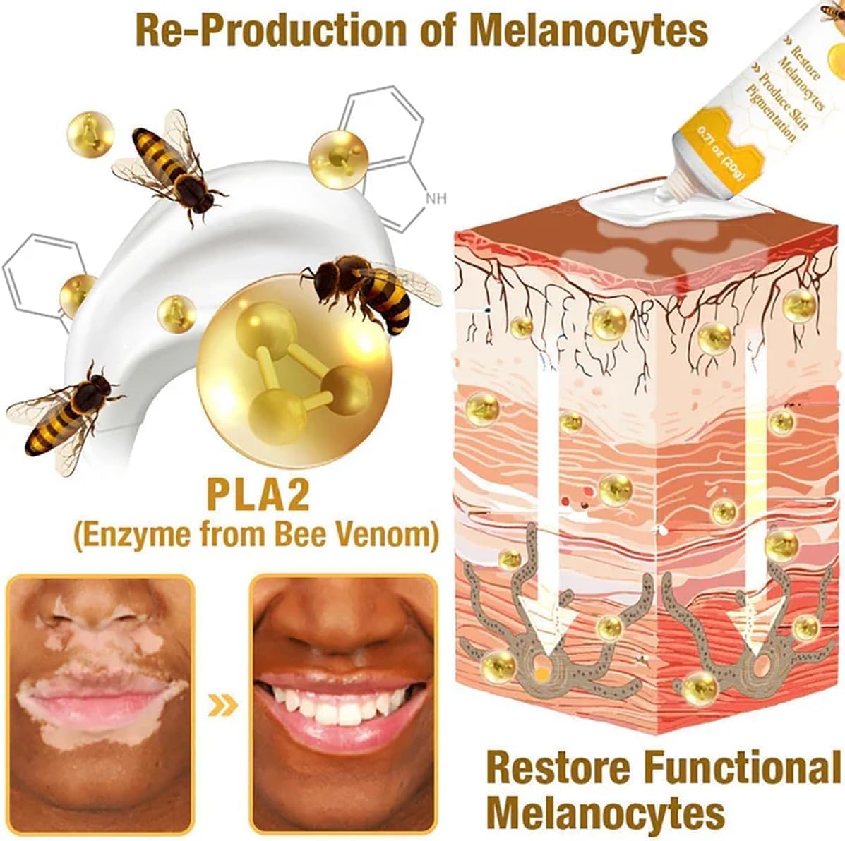 Bee Venom Vitiligo Cream, Beevenom Vitiligo Treatment Cream for All Skin Types