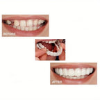 Pair of Snap-On Teeth Covers – Natural Look, Instant Smile Upgrade