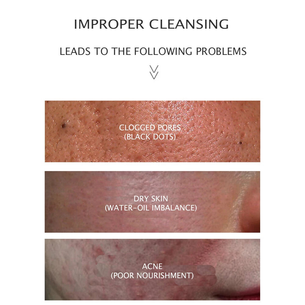 JOMTAM Amino Acid Cleansing Facial Anti-Acne Essence Moisturizing Removed Mites